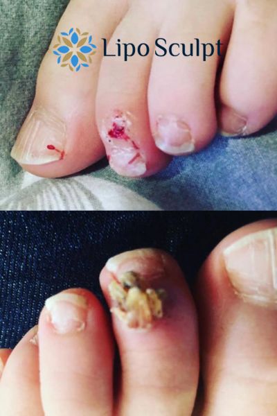 Wart removal customer results from Lipo Sculpt St Neots